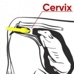 how to check a cow's cervix during calving