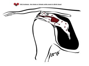 respiratory complications in newborn calves